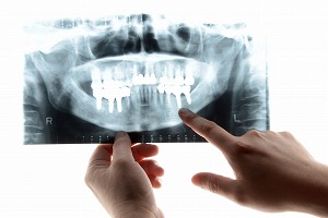 歯冠修復