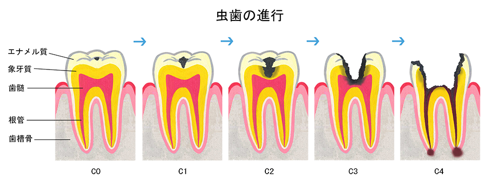 虫歯の進行段階と症状